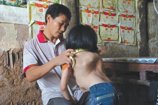 有嚴(yán)重脊椎畸形及胸腔隆突病的李文霞。