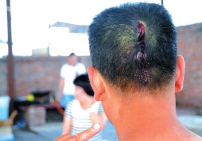 崔先生頭部受傷。京華時(shí)報(bào)記者趙思衡攝/視頻