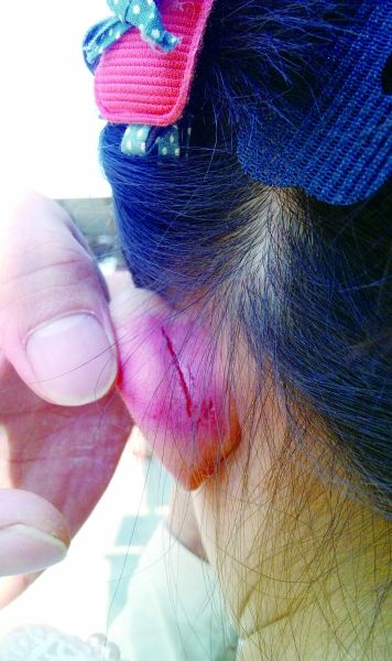 　　女童的耳朵被老師揪裂。圖片由女童家人提供