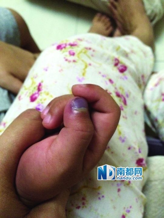 小逸手指被夾傷。