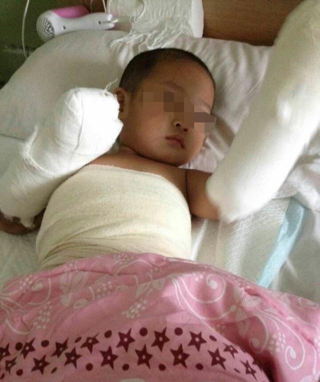 2歲娃洗澡跌入開水鍋 雙手嚴重燙傷