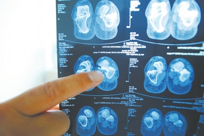 X光片顯示,確實有一根殘留的螺絲釘。