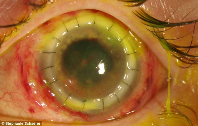 恐怖慎入！隱形眼鏡致英女子摘除眼球