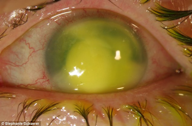 恐怖慎入！隱形眼鏡致英女子摘除眼球