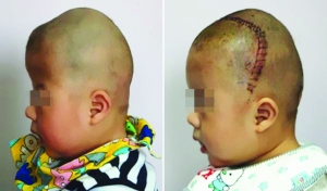 術(shù)前（左），術(shù)后（右）