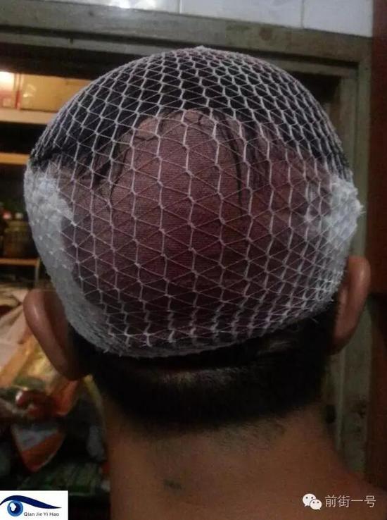 李律師受傷后縫合三針。