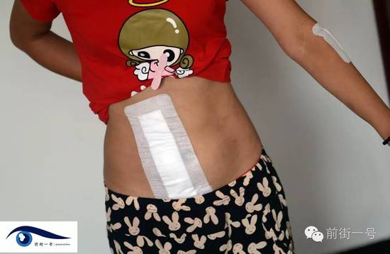 小金腹部的傷口。