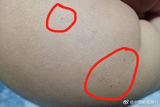 據(jù)多名紅黃藍(lán)(新天地分園)家長(zhǎng)反映，孩子腿部、屁股、腋下出現(xiàn)針眼。