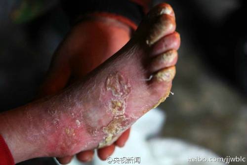 男孩皮膚一碰就破 裹衛(wèi)生紙堅持上學(xué)