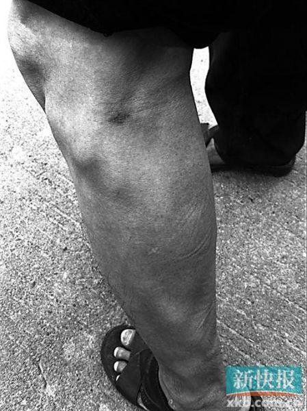 傷者身上遺留的彈痕。