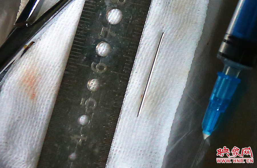 上午11點42分，大龍顱內(nèi)的鋼針被取出