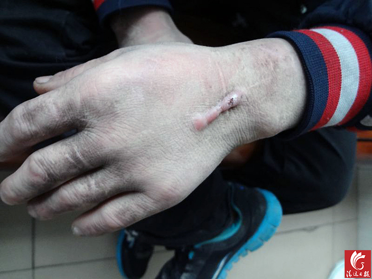 被發(fā)現(xiàn)男子手上的傷疤。