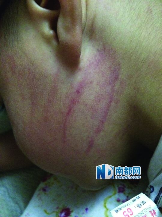 小逸臉上淤痕清晰可見(jiàn)。