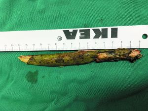 插入男子腦內(nèi)的樹(shù)枝。