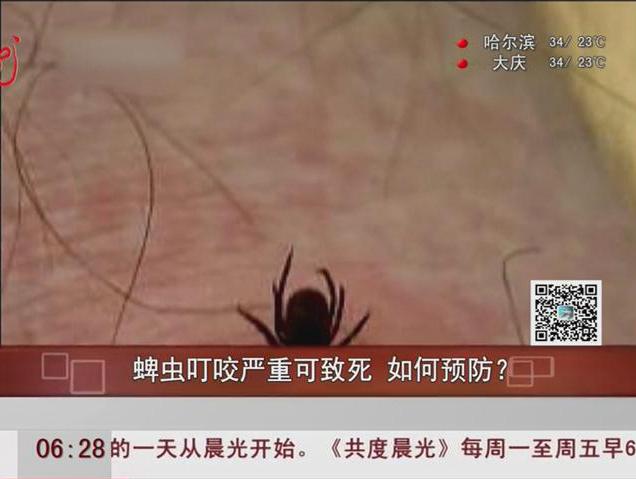 蜱蟲叮咬嚴重可致死如何預防？